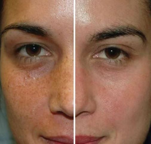 Peeling Quimico